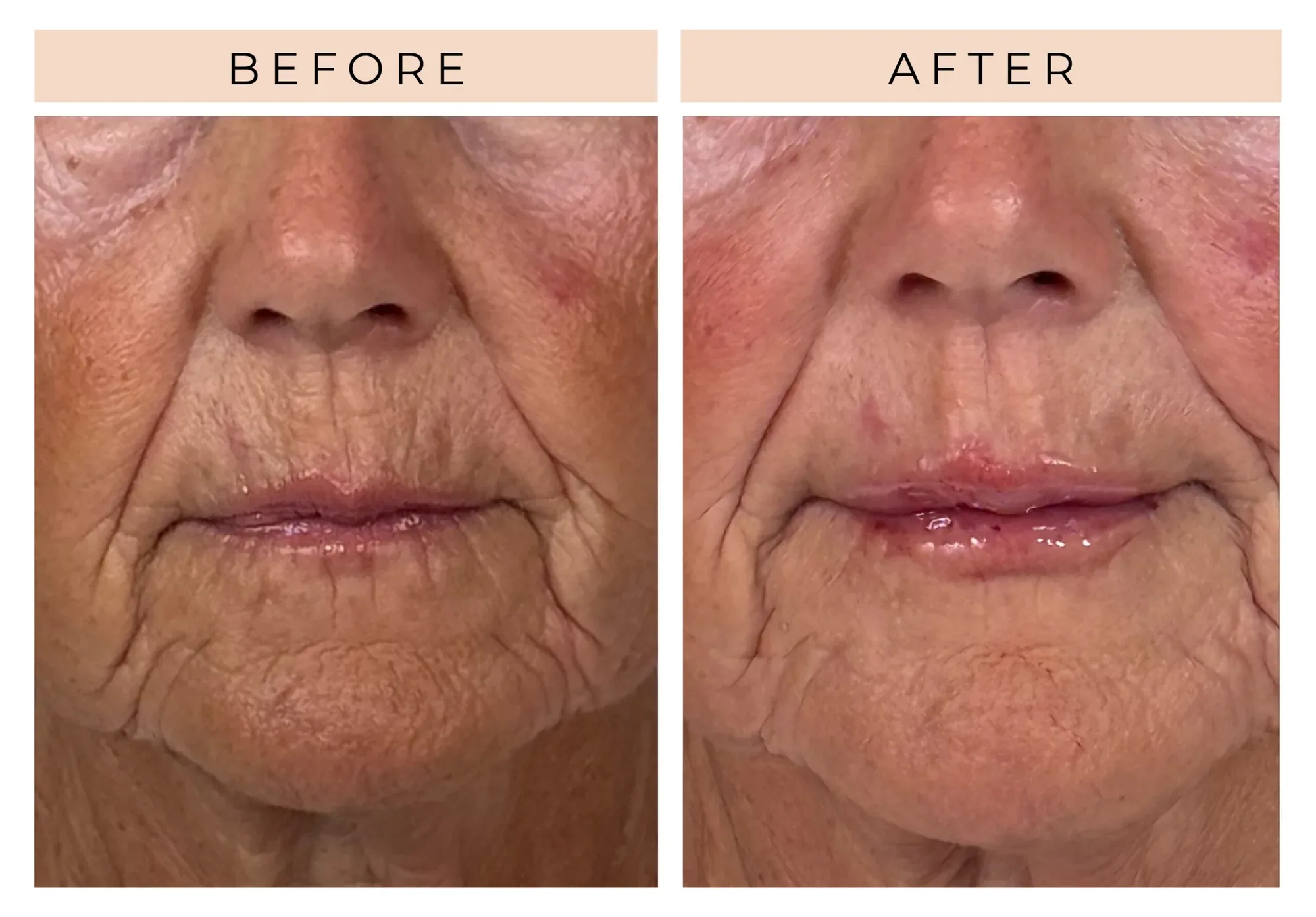Lip Filler – Natural Lip Enhancement - Before & After
