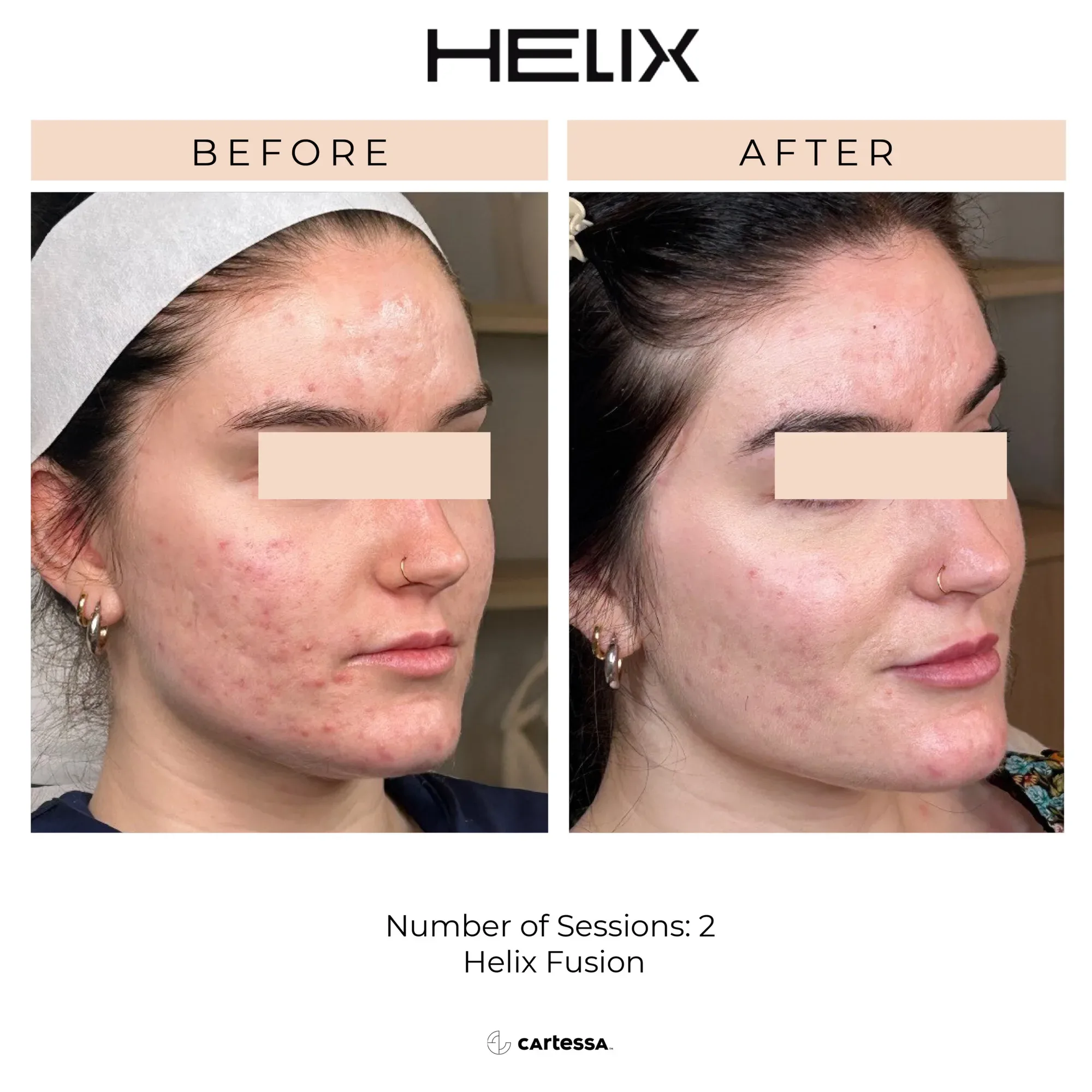 Helix CO2 Laser Resurfacing - Before & After