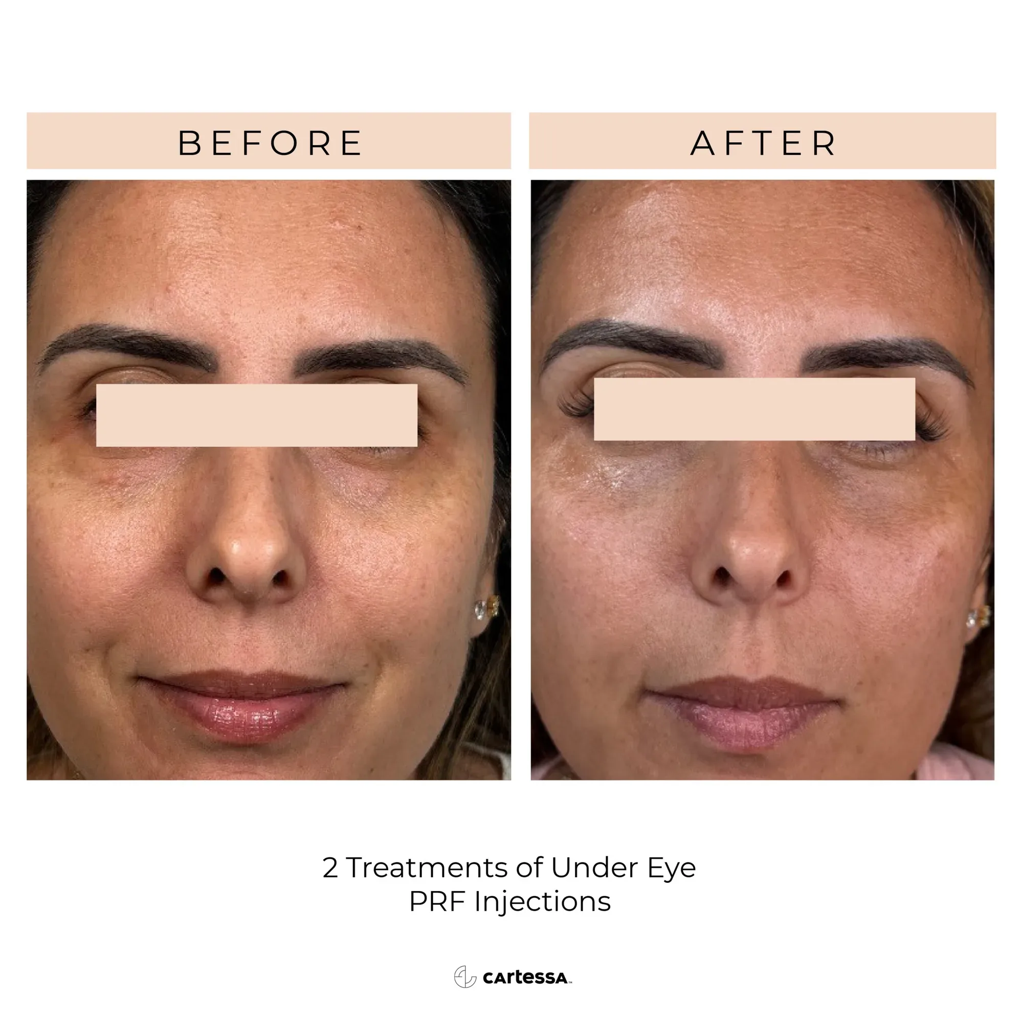Under-Eye PRF – 2 Treatments - Before & After