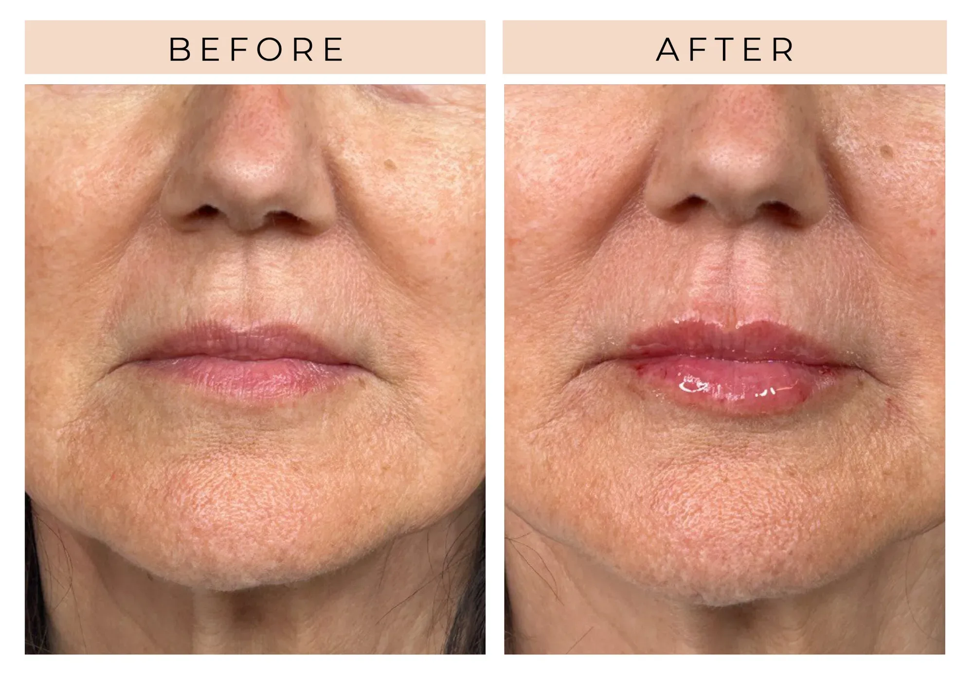 Helix CO2 Laser – Fine Line & Wrinkle Reduction - Before & After
