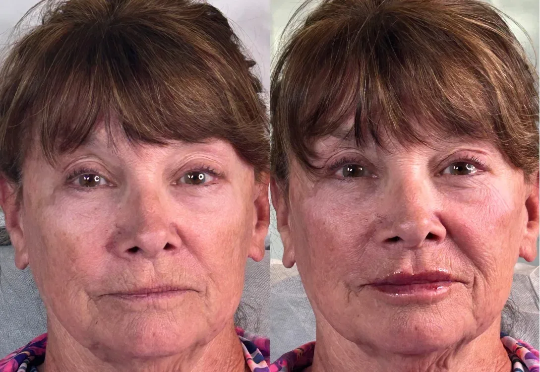 Dermal Fillers – Facial Volume Restoration - Before & After